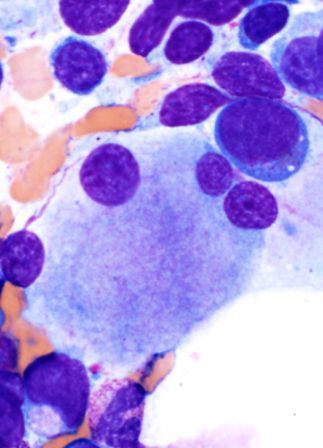 Abnormal osteoclast-like megakaryocyte